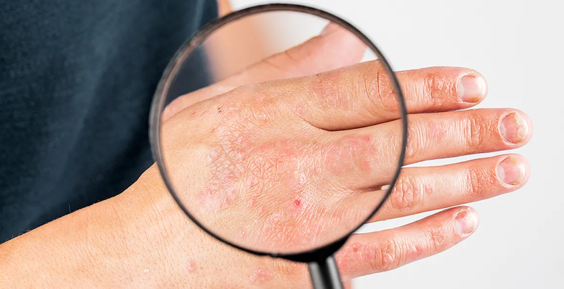 Atopic Dermatitis And Diet: Is There A Connection?