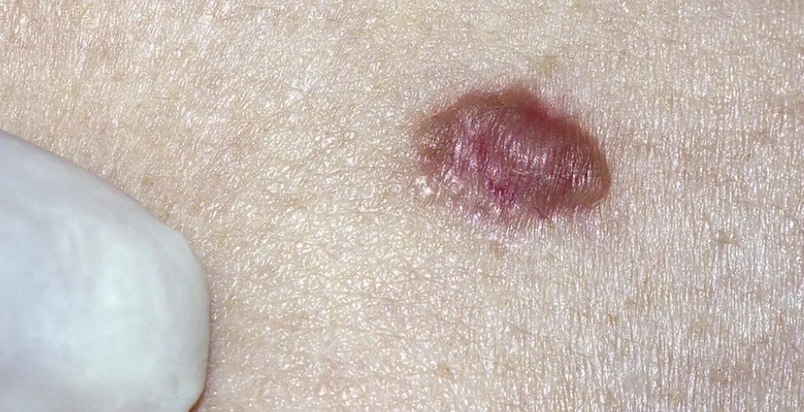 Can Skin Cancer Stay Hidden For Years Without Signs?
