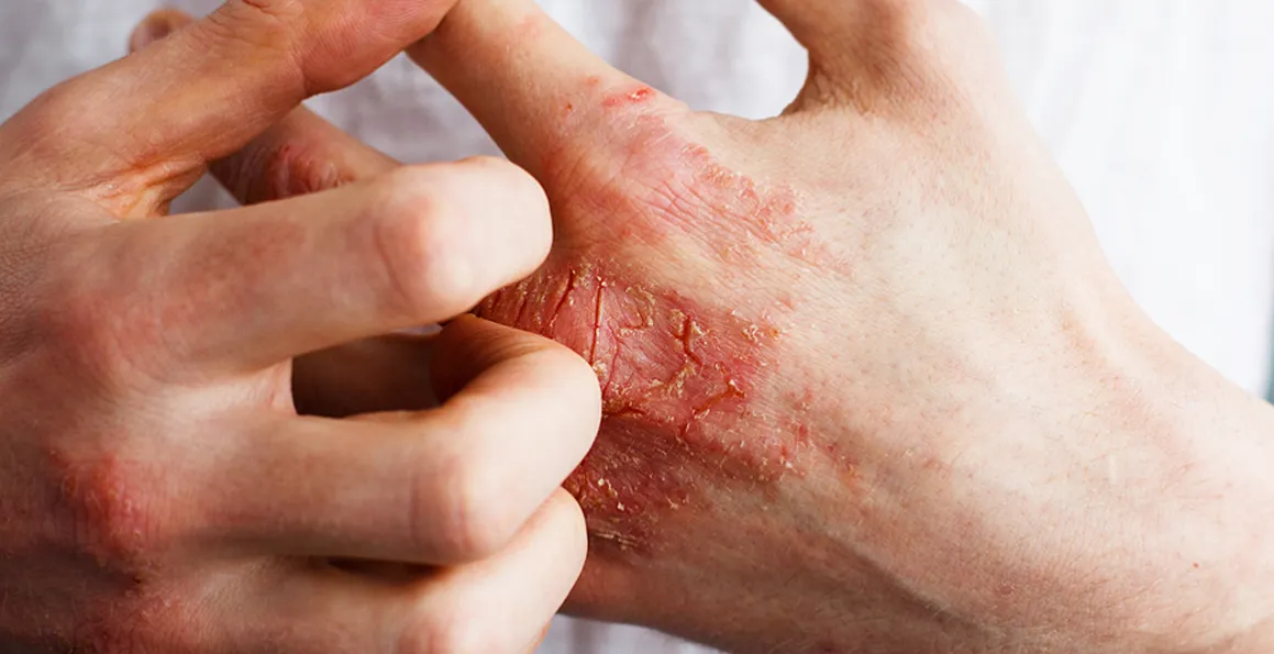Debunking the Most Common Myths Surrounding Eczema