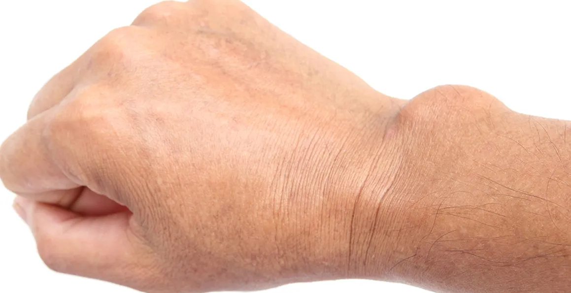 Diagnosis To Recovery: A Guide To Cyst Surgery In Singapore