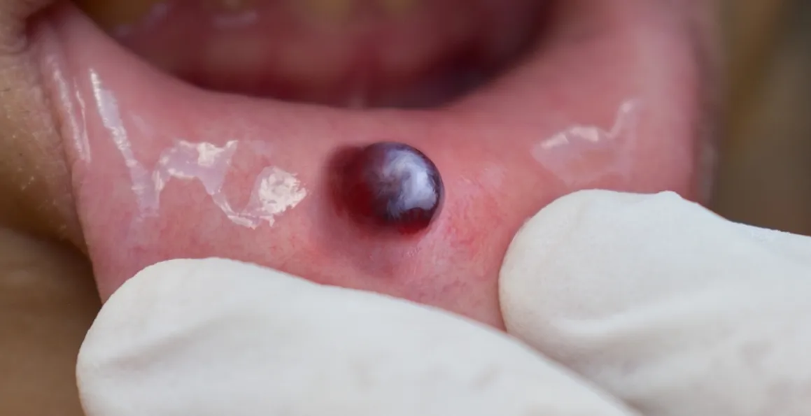 Different Types Of Skin Cysts And How Are They Treated?