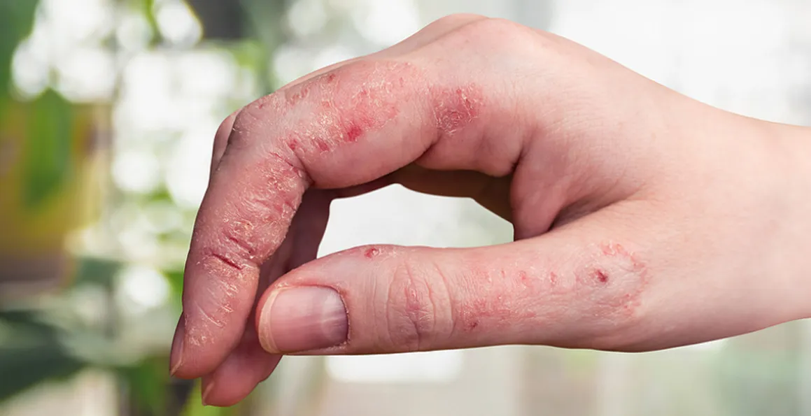 Eczema Or Psoriasis: Which Skin Condition Do You Have?