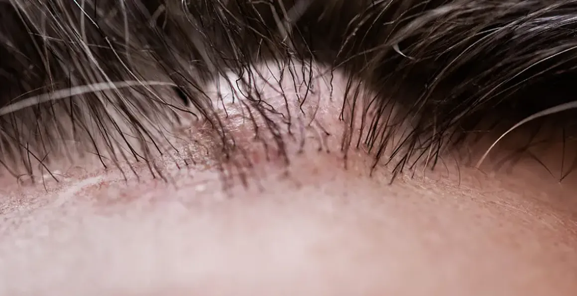 Epidermal Cysts: Common Causes, Symptoms, and Treatments