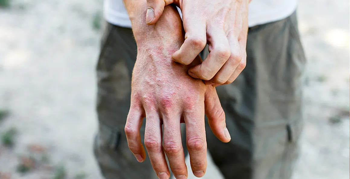 Managing Eczema In Singapore's Climate: A Dermatologist's Advice