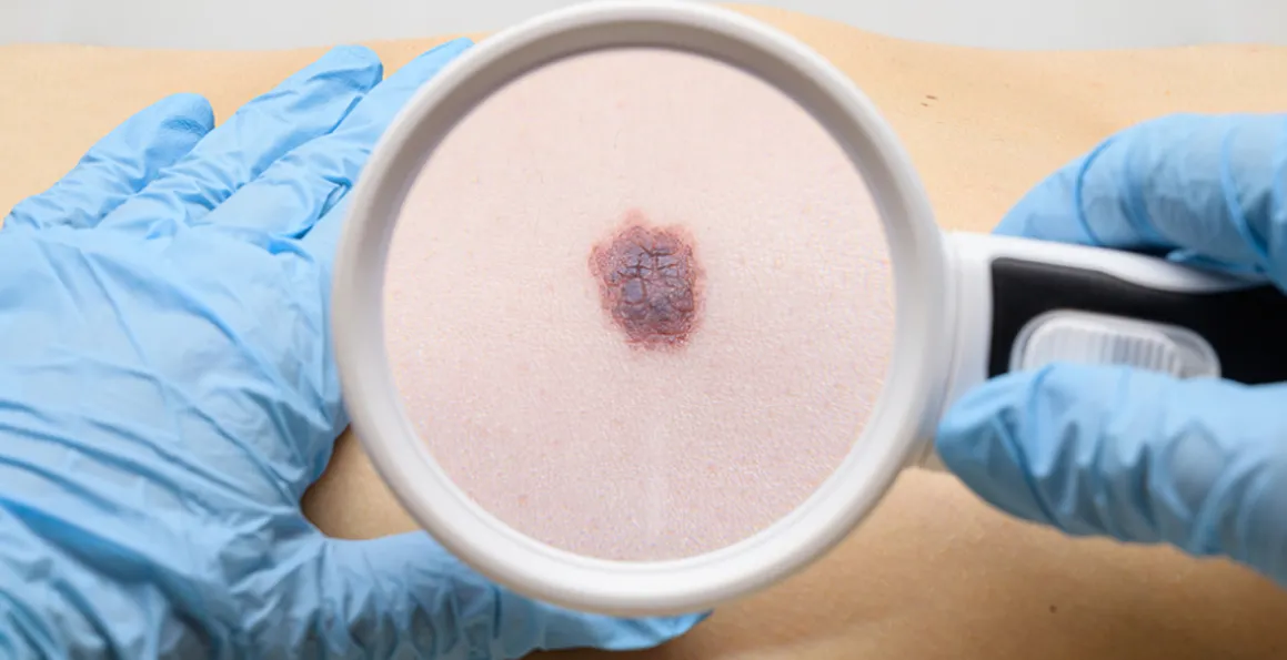 Moles Vs Skin Cancer: The Key Differences Explained