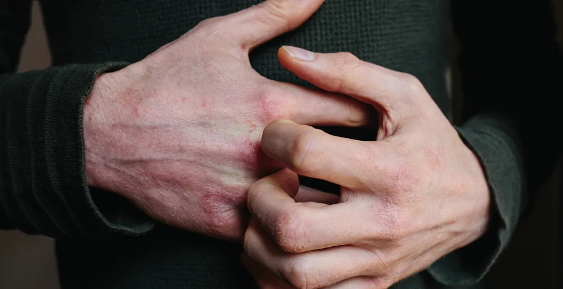 Severe Eczema: Symptoms, Diagnosis, And Treatment Options