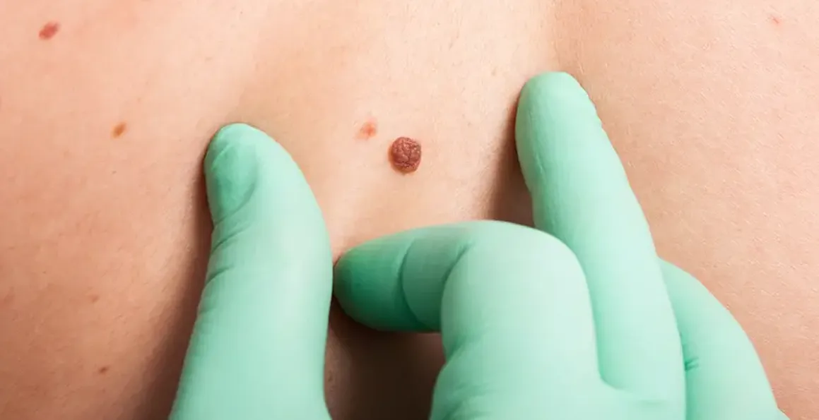 Skin Cancer: Answering the Most Frequently Asked Questions