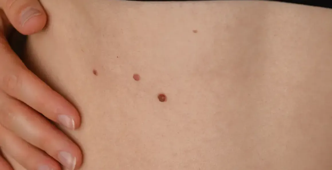 Skin Cancer Awareness: Early Detection and Prevention Tips