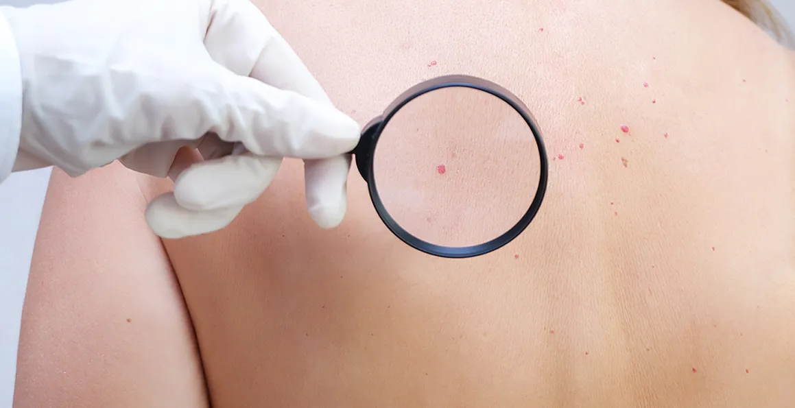 Skin Cancer Recurrence: Monitoring And Follow-Up Tips