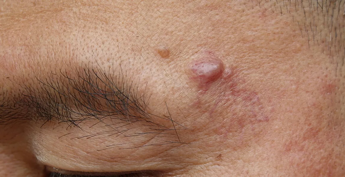 Skin Cyst Removal: When Is It Necessary To Avoid Pain?