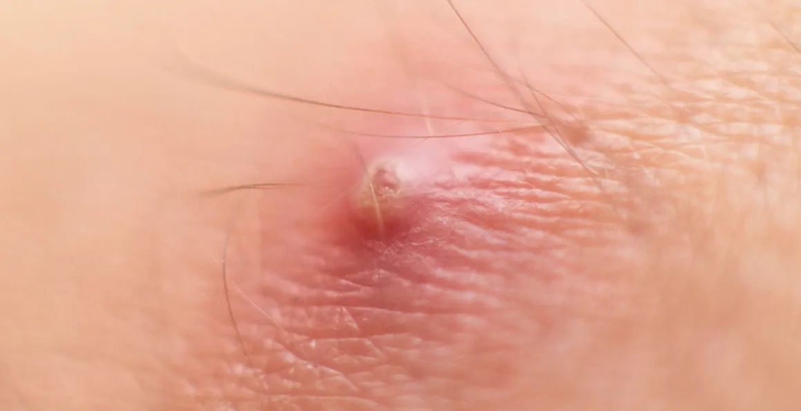 The Differences Between A Skin Cyst And A Boil (Abscess)
