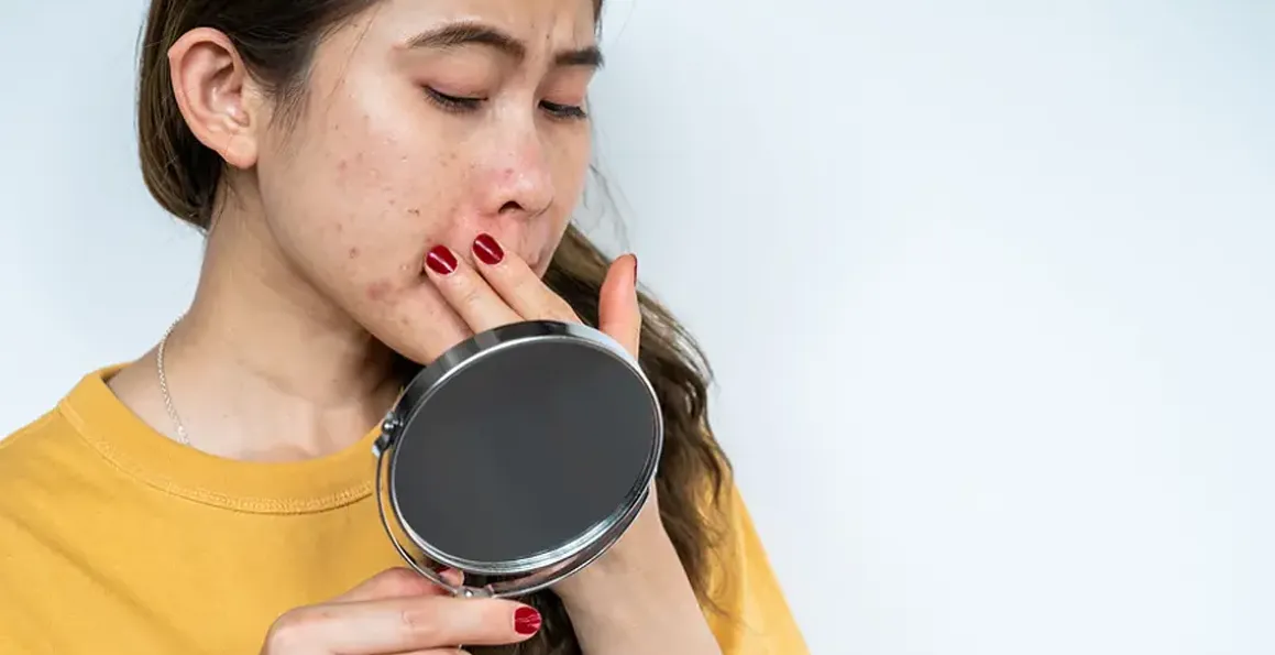 The Science of Acne: Causes, Myths, and Effective Treatments