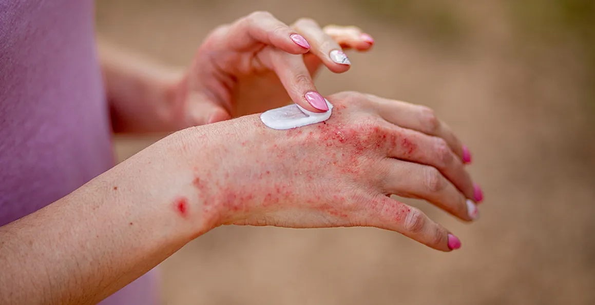 What Causes Eczema? Causes, Triggers And Tips For Prevention