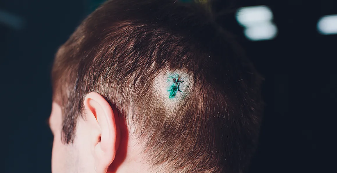 What Happens To The Scar After Cyst Removal Surgery?