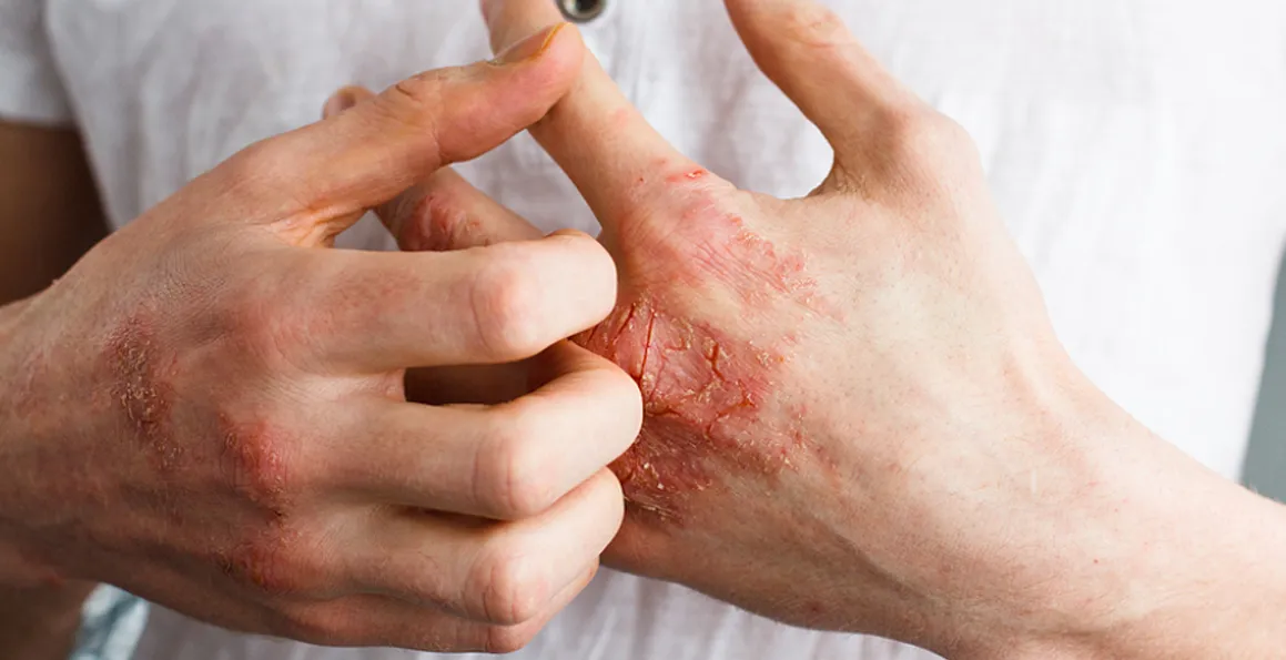 Will Eczema Heal On Its Own If You Stop Scratching?