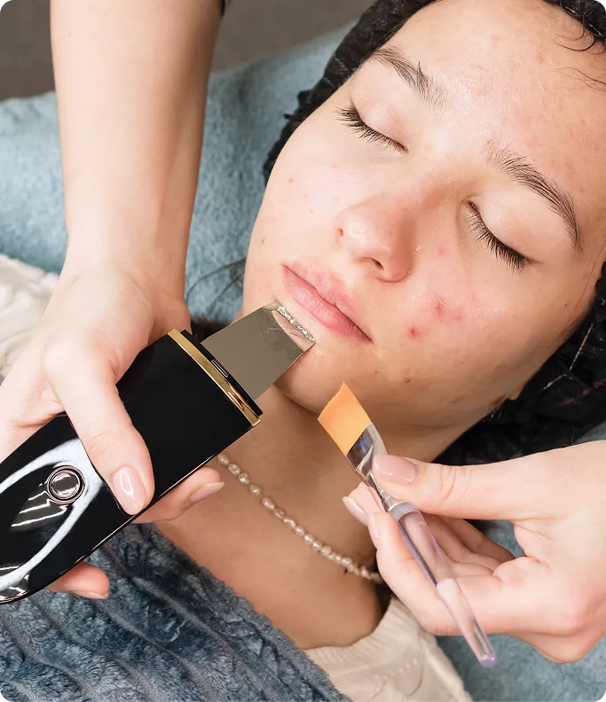 How is Acne Scarring Treated at TSN Dermatology?