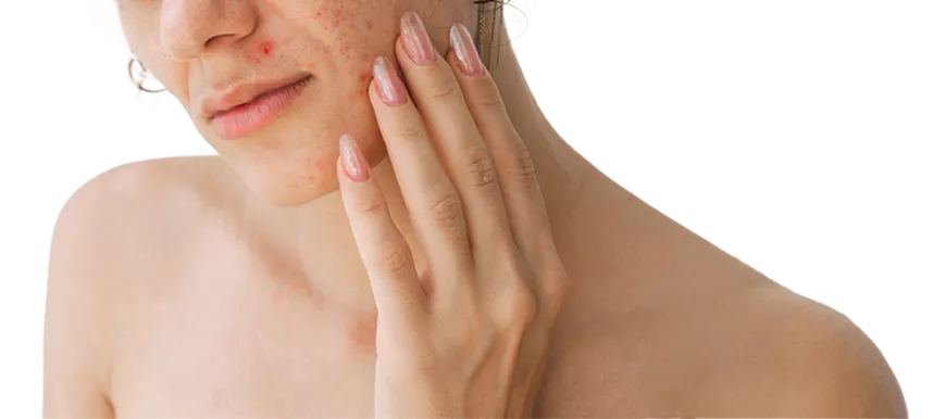 Acne Scar Treatment in Singapore
