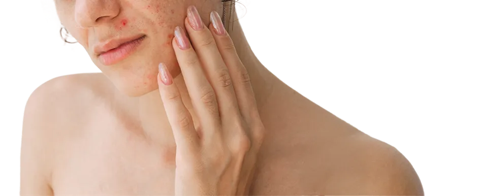 Acne treatment in Singapore