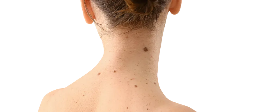 Benign Skin Growths in Singapore