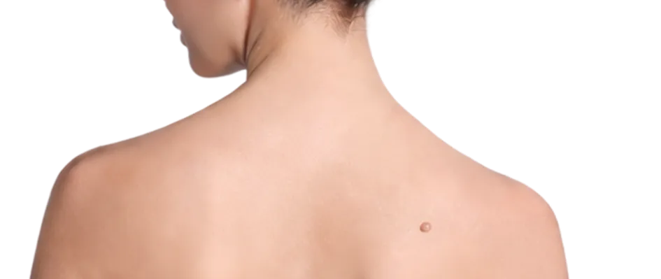 Cyst Removal Surgery in Singapore