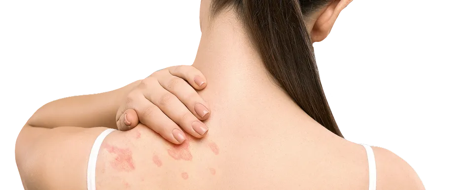 Hives (Urticaria) Treatment in Singapore