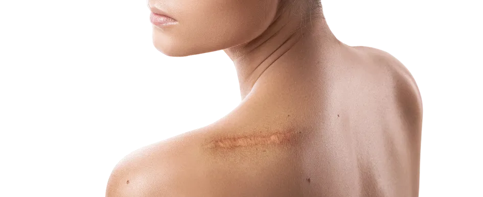 Keloid Scars Treatment in Singapore