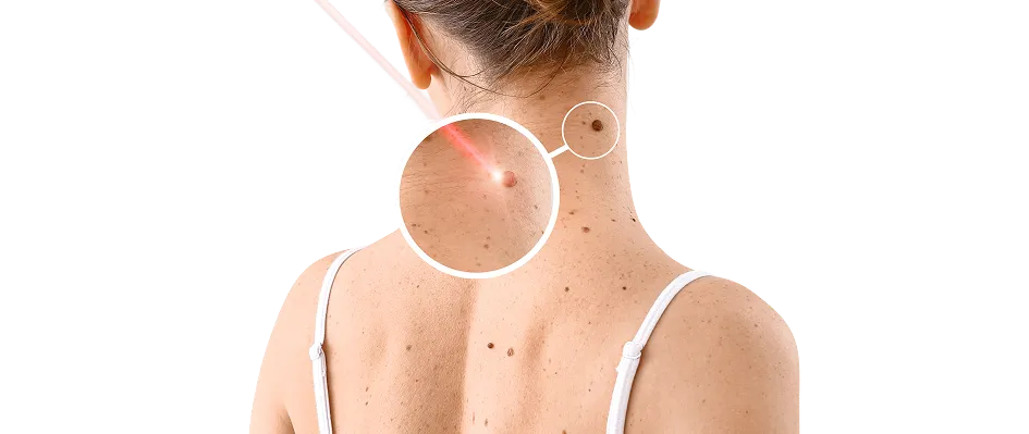 Mole Removal in Singapore