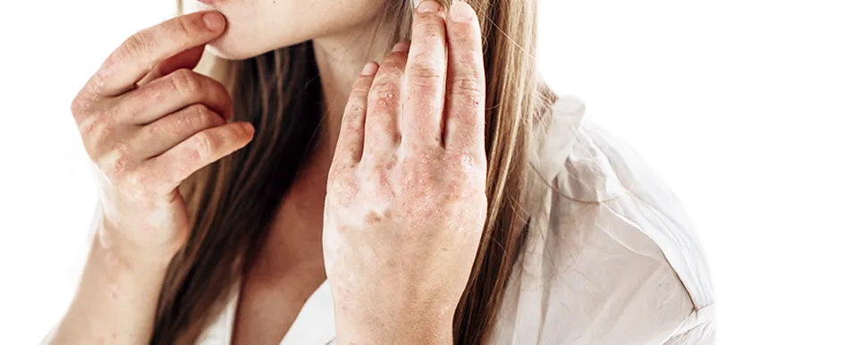 Psoriasis treatment in Singapore
