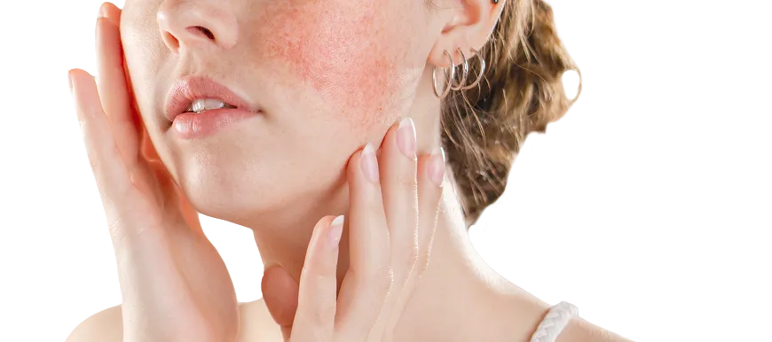 Rosacea Treatment in Singapore