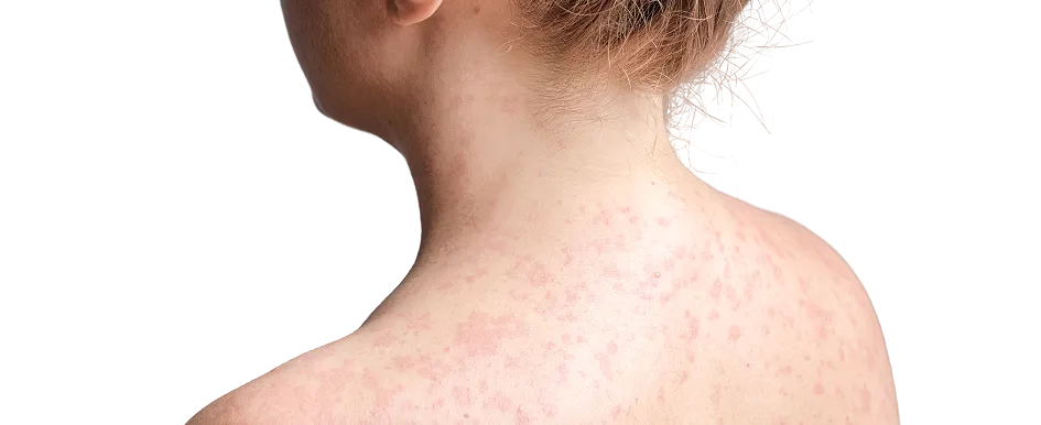 Skin Allergy Test & Treatment in Singapore