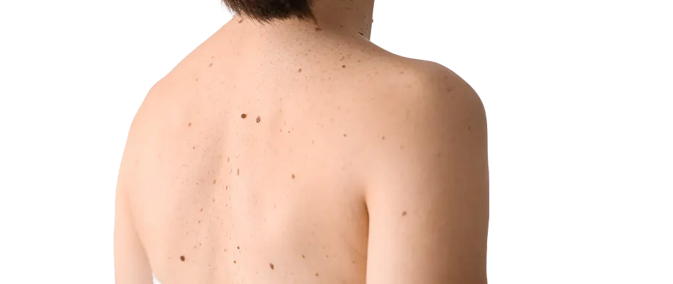 Skin Cancer Screening in Singapore