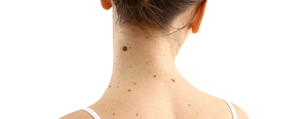 Skin Cancer Surgery in Singapore