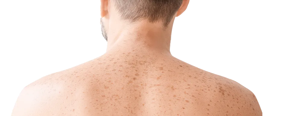 Treatment for Skin Pigmentation in Singapore