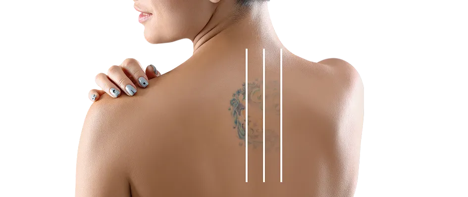 Tattoo Removal in Singapore