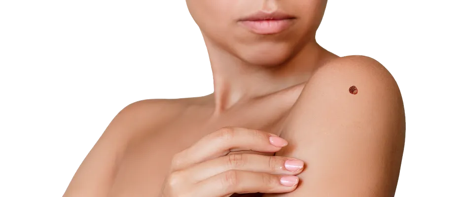 Warts Removal in Singapore