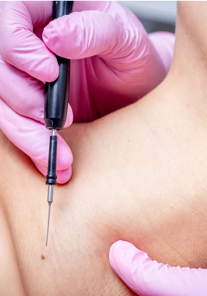 How Are Benign Skin Growths Treated at TSN Dermatology?