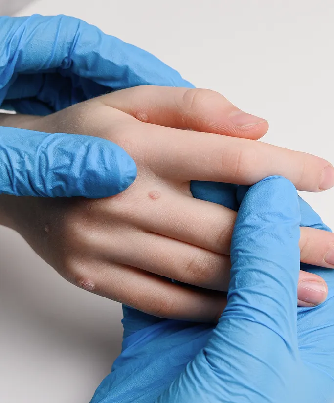 How Are Cysts Treated at TSN Dermatology?