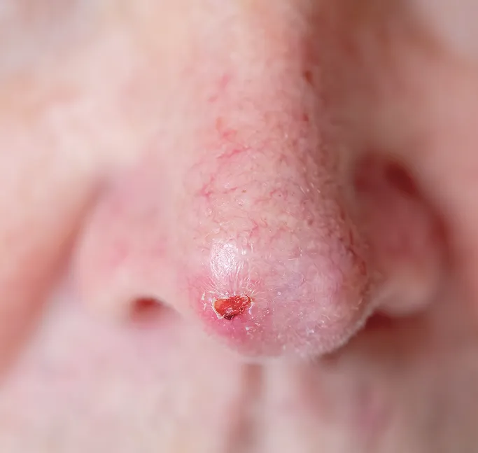 How Does Mohs Micrographic Surgery Work?