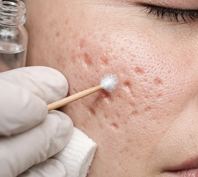 How Does TCA CROSS Work?