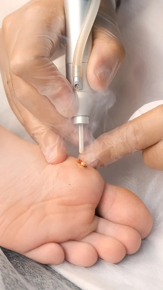 How Are Warts Treated and Removed at TSN Dermatology?