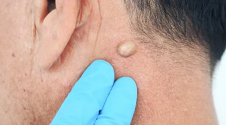 Cyst Removal Surgery