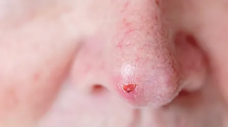 Mohs Micrographic Surgery