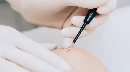 Mole Removal