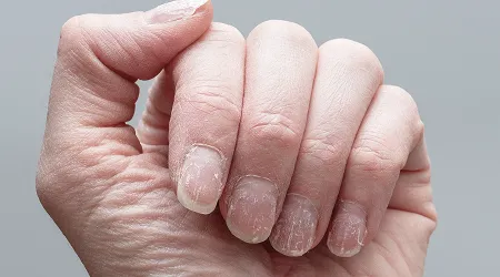 Nail Conditions