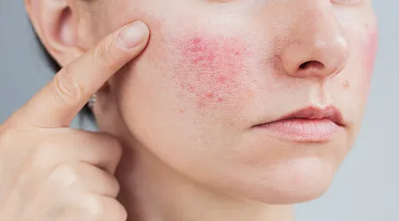 Rosacea Treatment