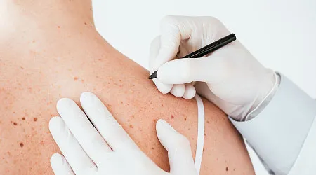 Skin Cancer Screening & Mole Check
