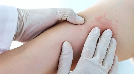 Treatment for Skin Infections