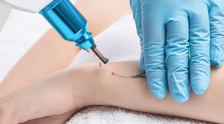 Tattoo Removal