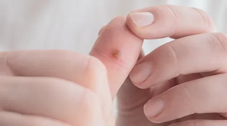 Warts Removal