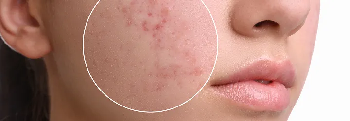 Acne, Rosacea and Maskne